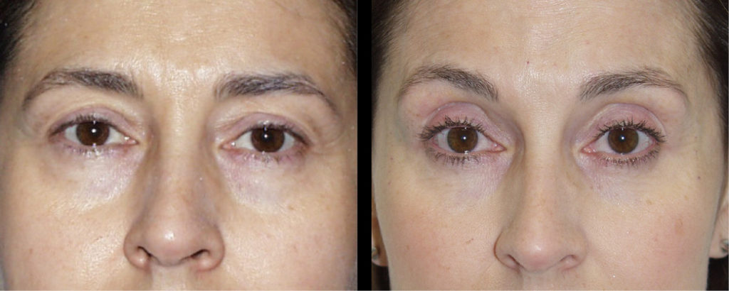 cortez facial plastic surgery brow 4 cortez facial plastic surgery brow 4