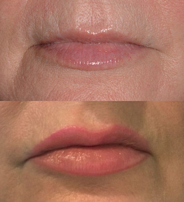 lip-filler-eblast lip filler before and after